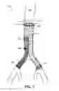 Fig. 06 - Endograft visualization with optical shape sensing