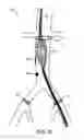 Fig. 07 - Endograft visualization with optical shape sensing