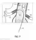 Fig. 08 - Endograft visualization with optical shape sensing