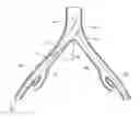 Fig. 01 - Introducer for a side branch device