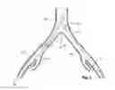 Fig. 03 - Introducer for a side branch device
