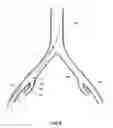 Fig. 07 - Introducer for a side branch device