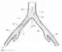 Fig. 01 - Introducer for a side branch device