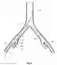Fig. 06 - Introducer for a side branch device