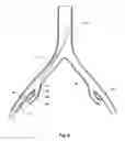 Fig. 07 - Introducer for a side branch device