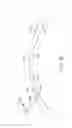 Fig. 52 - Conformable therapeutic shield for vision and pain