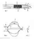 Fig. 02 - SYSTEM FOR INSTALLING AN INPLANT, IMPLANT, AND INSTALLATION TOOL