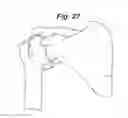 Fig. 09 - SHOULDER ARTHROPLASTY INSTRUMENTATION