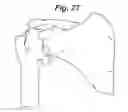 Fig. 09 - SHOULDER ARTHROPLASTY INSTRUMENTATION