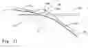 Fig. 12 - Method for placement of neuromonitoring needles