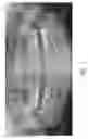 Fig. 02 - Therapeutic tooth bud ablation