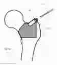 Fig. 08 - HIP REPLACEMENT SYSTEMS AND METHODS