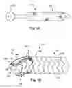 Fig. 02 - Frame structures, stent grafts incorporating the same, and methods for extended aortic repair