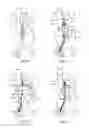 Fig. 04 - Controlled expansion stent graft delivery system