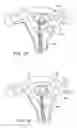 Fig. 04 - Intra uterine device