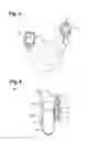 Fig. 03 - VAGUS NERVE STIMULATION AND SUBCUTANEOUS DEFIBRILLATION SYSTEM