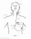 Fig. 08 - VAGUS NERVE STIMULATION AND SUBCUTANEOUS DEFIBRILLATION SYSTEM