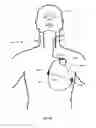 Fig. 09 - VAGUS NERVE STIMULATION AND SUBCUTANEOUS DEFIBRILLATION SYSTEM