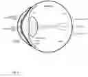 Fig. 02 - Eye mounted device for controlling focusing disorders