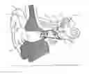 Fig. 01 - Adjustable venting for hearing instruments