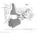 Fig. 02 - Adjustable venting for hearing instruments