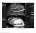 Fig. 07 - Method for evaluating blush in myocardial tissue