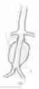 Fig. 05 - Dual inflatable arterial prosthesis