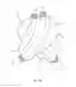 Fig. 07 - Dual inflatable arterial prosthesis