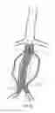 Fig. 08 - Dual inflatable arterial prosthesis