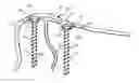 Fig. 01 - Orthopaedic device for correction of deformities in a bone