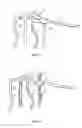 Fig. 08 - Orthopaedic device for correction of deformities in a bone