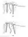 Fig. 09 - Orthopaedic device for correction of deformities in a bone
