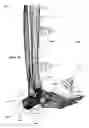 Fig. 35 - Clamping device for use with an anatomic external fixation device