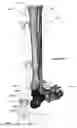 Fig. 43 - Clamping device for use with an anatomic external fixation device