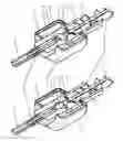 Fig. 01 - Bone cement applicator with three-way valve for pressure relief
