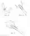 Fig. 02 - Method and device for uterine fibroid treatment