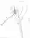 Fig. 19 - Method and device for uterine fibroid treatment