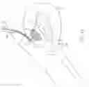 Fig. 22 - Method and device for uterine fibroid treatment