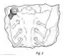 Fig. 03 - Sacroiliac joint immobilization