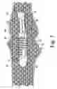 Fig. 06 - PROSTHETIC COMPONENT AND ASSOCIATED METHODS FOR A BONE FUSION PROCEDURE