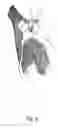 Fig. 07 - Joint prosthesis with removal device