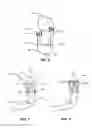 Fig. 06 - Modular Prosthetic Sockets and Method for Making Same