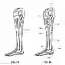 Fig. 15 - Modular Prosthetic Sockets and Method for Making Same