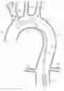 Fig. 01 - SELF-ORIENTING ENDOVASCULAR DELIVERY SYSTEM