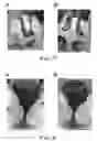 Fig. 07 - Multi-petaled mounting members for ostomy pouches