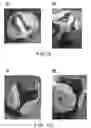Fig. 08 - Multi-petaled mounting members for ostomy pouches