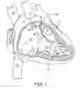 Fig. 02 - Interventional medical systems and associated assemblies and methods