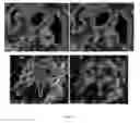 Fig. 31 - Systems and methods for segmentation and processing of tissue images and feature extraction from same for treating, diagnosing, or predicting medical conditions