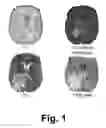 Fig. 02 - Automatic 3D brain tumor segmentation and classification