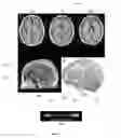 Fig. 08 - Quantifying mass effect deformation with structural radiomics in brain tumor patients